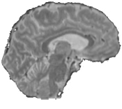 MRI sagittal slice