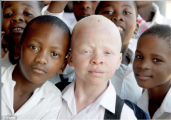 Photo of albino and non-albino children